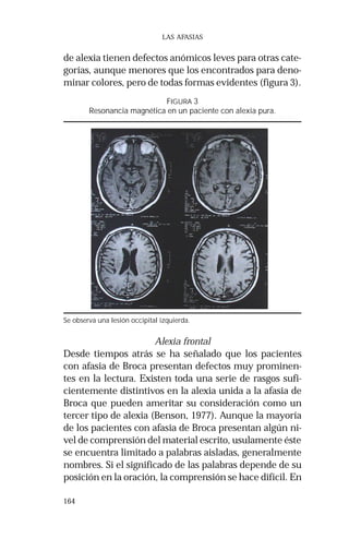 164
LAS AFASIAS
FIGURA 3
Resonancia magnética en un paciente con alexia pura.
Se observa una lesión occipital izquierda.
de alexia tienen defectos anómicos leves para otras cate-
gorías, aunque menores que los encontrados para deno-
minar colores, pero de todas formas evidentes (figura 3).
Alexia frontal
Desde tiempos atrás se ha señalado que los pacientes
con afasia de Broca presentan defectos muy prominen-
tes en la lectura. Existen toda una serie de rasgos sufi-
cientemente distintivos en la alexia unida a la afasia de
Broca que pueden ameritar su consideración como un
tercer tipo de alexia (Benson, 1977). Aunque la mayoría
de los pacientes con afasia de Broca presentan algún ni-
vel de comprensión del material escrito, usulamente éste
se encuentra limitado a palabras aisladas, generalmente
nombres. Si el significado de las palabras depende de su
posición en la oración, la comprensión se hace difícil. En
 