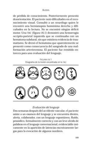 189
ALEXIA
de pérdida de conocimiento. Posteriormente presentó
desorientación. El paciente notó dificultades en el reco-
nocimiento visual. Consultó a un neurólogo quien le
encontró una hemianopsia homónima derecha y difi-
cultades en la lectura. No se encontró ningún déficit
motor. Una TAC (figura C6.1) demostró una hemorragia
occipito-parietal izquierda que se continuaba con un
hematoma subdural, sin que existiera evidencia de trau-
matismo. Se drenó el hematoma que aparentemente se
presentó como consecuencia del sangrado de una mal-
formación arteriovenosa. El paciente fue remitido en-
tonces para una evaluación del lenguaje.
FIGURA C6.1
Diagrama de la lesión encontrada en la TAC
Evaluación del lenguaje
Dos semanas después del accidente vascular, el paciente
asiste a un examen del lenguaje y se encuentra diestro,
alerta, colaborador, con un lenguaje espontáneo, fluido,
prosódico, formalmente correcto y con un leve olvido de
palabras en el lenguaje conversacional, evidenciable úni-
camente en la aparición de latencias excesivamente lar-
gas para la evocación de algunos nombres.
 