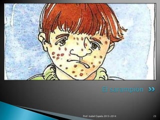 El sarampión

Prof. Isabel Capela 2013-2014

23

 