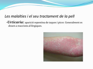 Les malalties i el seu tractament de la pell
·Urticaria: aparició repentina de taques i picor. Generalment es
deuen a reaccions al·lèrgiques.

 