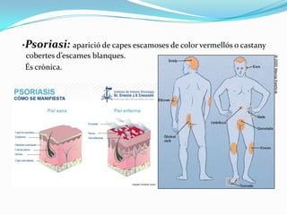 ·Psoriasi: aparició de capes escamoses de color vermellós o castany
cobertes d’escames blanques.
És crònica.

 