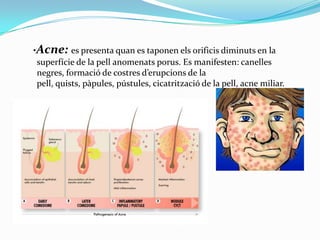 ·Acne: es presenta quan es taponen els orificis diminuts en la
superfície de la pell anomenats porus. Es manifesten: canelles
negres, formació de costres d’erupcions de la
pell, quists, pàpules, pústules, cicatrització de la pell, acne miliar.

 