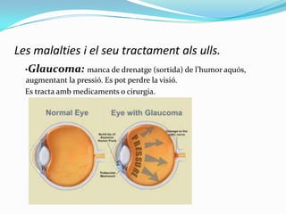 Les malalties i el seu tractament als ulls.
·Glaucoma: manca de drenatge (sortida) de l’humor aquós,
augmentant la pressió. Es pot perdre la visió.
Es tracta amb medicaments o cirurgia.

 