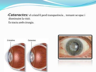 ·Cataractes: el cristal·lí perd transparència ,
disminuint la visió.
Es tracta amb cirurgia.

tornant-se opac i

 