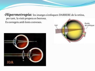 ·Hipermetropia: les imatges s’enfoquen DARRERE de la retina,
per tant, la visió propera es borrosa.
Es corregeix amb lents convexes.

 