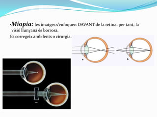 ·Miopia: les imatges s’enfoquen DAVANT de la retina, per tant, la
visió llunyana és borrosa.
Es corregeix amb lents o cirurgia.

 