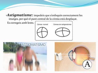 ·Astigmatisme: impedeix que s’enfoquin correctament les
imatges, per què el punt central de la còrnia està desplaçat.
Es corregeix amb lents.

 