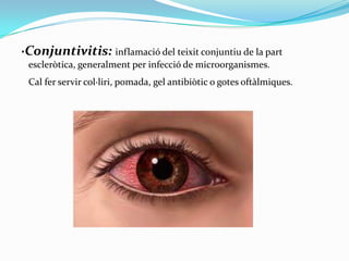 ·Conjuntivitis: inflamació del teixit conjuntiu de la part
escleròtica, generalment per infecció de microorganismes.
Cal fer servir col·liri, pomada, gel antibiòtic o gotes oftàlmiques.

 