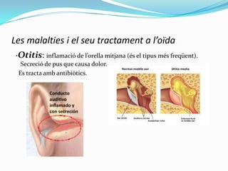 Les malalties i el seu tractament a l’oïda
·Otitis: inflamació de l’orella mitjana (és el tipus més freqüent).
Secreció de pus que causa dolor.
Es tracta amb antibiòtics.

 