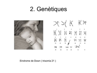 2. Genètiques Síndrome de Down ( trisomia 21 ) 