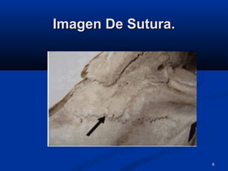 6
Imagen De Sutura.Imagen De Sutura.
 