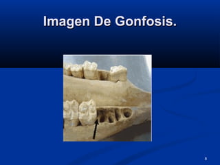 8
Imagen De Gonfosis.Imagen De Gonfosis.
 