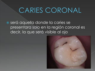    será aquella donde la caries se
    presentara solo en la región coronal es
    decir, la que será visible al ojo
 
