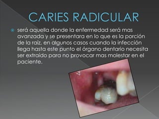    será aquella donde la enfermedad será mas
    avanzada y se presentara en lo que es la porción
    de la raíz, en algunos casos cuando la infección
    llega hasta este punto el órgano dentario necesita
    ser extraído para no provocar mas molestar en el
    paciente.
 