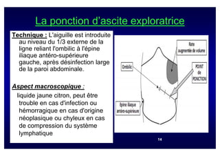 La ponction d’ascite exploratrice
Technique : L'aiguille est introduite
  au niveau du 1/3 externe de la
  ligne reliant l'ombilic à l'épine
  iliaque antéro-supérieure
  gauche, après désinfection large
  de la paroi abdominale.

Aspect macroscopique :
 liquide jaune citron, peut être
  trouble en cas d'infection ou
  hémorragique en cas d'origine
  néoplasique ou chyleux en cas
  de compression du système
  lymphatique
                                        14
 