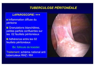 TUBERCULOSE PÉRITONÉALE

     LAPAROSCOPIE:
     LAPAROSCOPIE: +++
 Inflammation diffuse du
péritoine
  Granulations blanchâtres,
petites parfois confluentes sur
les 02 feuillets péritonéaux
  Adhérence entre les 02
feuillets péritonéaux
     Bx:
     Bx: follicule de koester.
                      koester.
Traitement:
Traitement: schéma national anti
tuberculeux RHZ / RH
 