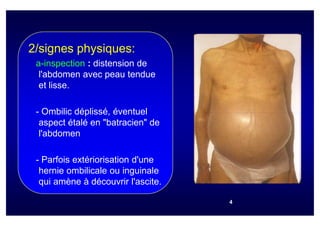 2/signes physiques:
 a-inspection : distension de
  l'abdomen avec peau tendue
  et lisse.

 - Ombilic déplissé, éventuel
  aspect étalé en "batracien" de
  l'abdomen

 - Parfois extériorisation d'une
  hernie ombilicale ou inguinale
  qui amène à découvrir l'ascite.

                                    4
 