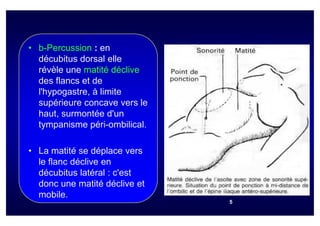• b-Percussion : en
  décubitus dorsal elle
  révèle une matité déclive
  des flancs et de
  l'hypogastre, à limite
  supérieure concave vers le
  haut, surmontée d'un
  tympanisme péri-ombilical.

• La matité se déplace vers
  le flanc déclive en
  décubitus latéral : c'est
  donc une matité déclive et
  mobile.
                               5
 