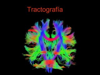 Tractografía 
 