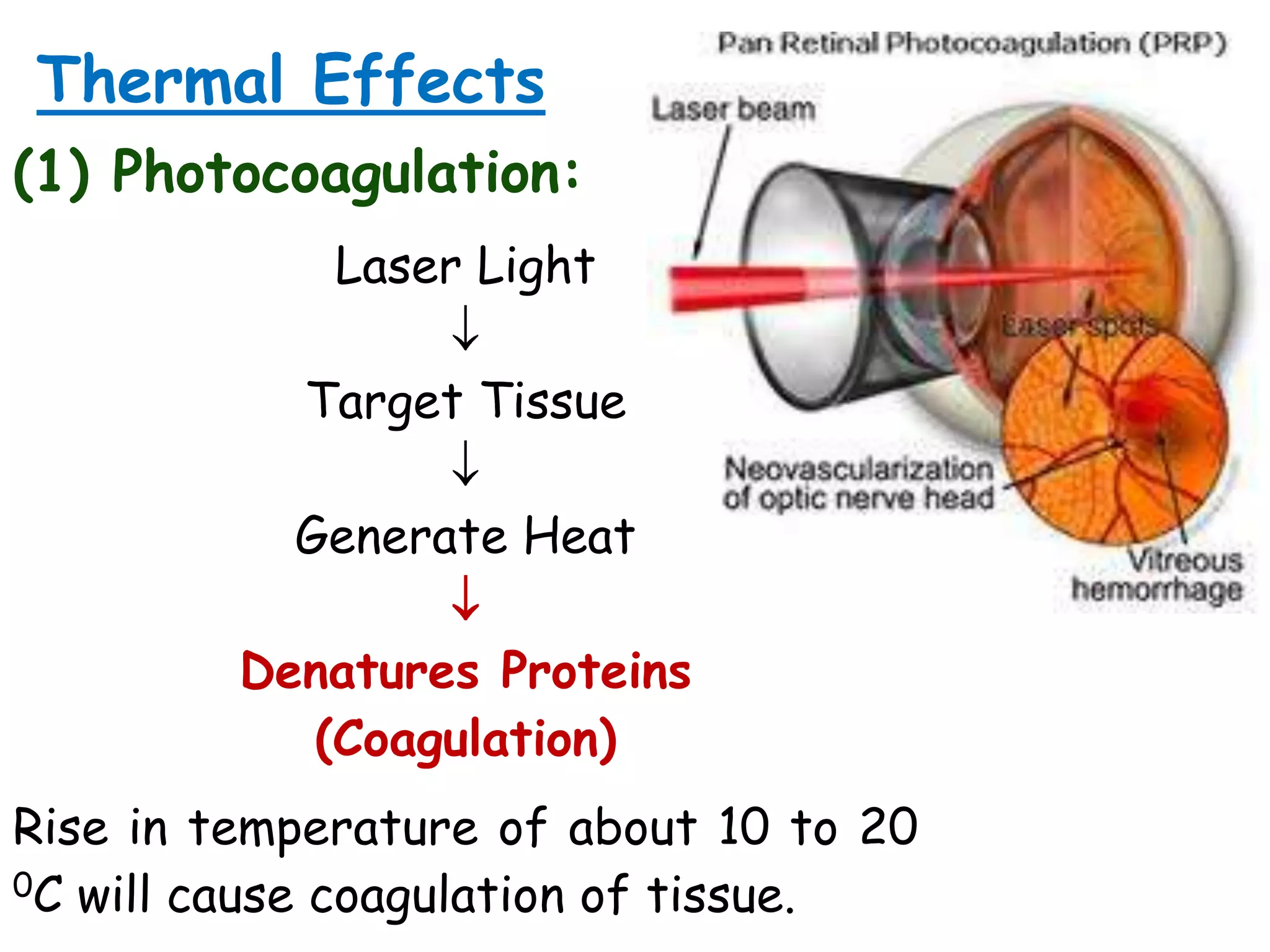 Thermal Effects
(1) Photocoagulation:
Laser Light
Target Tissue

Generate Heat
Denatures Proteins
(Coagulation)
Rise in temperature of about 10 to 20
0C will cause coagulation of tissue.

 