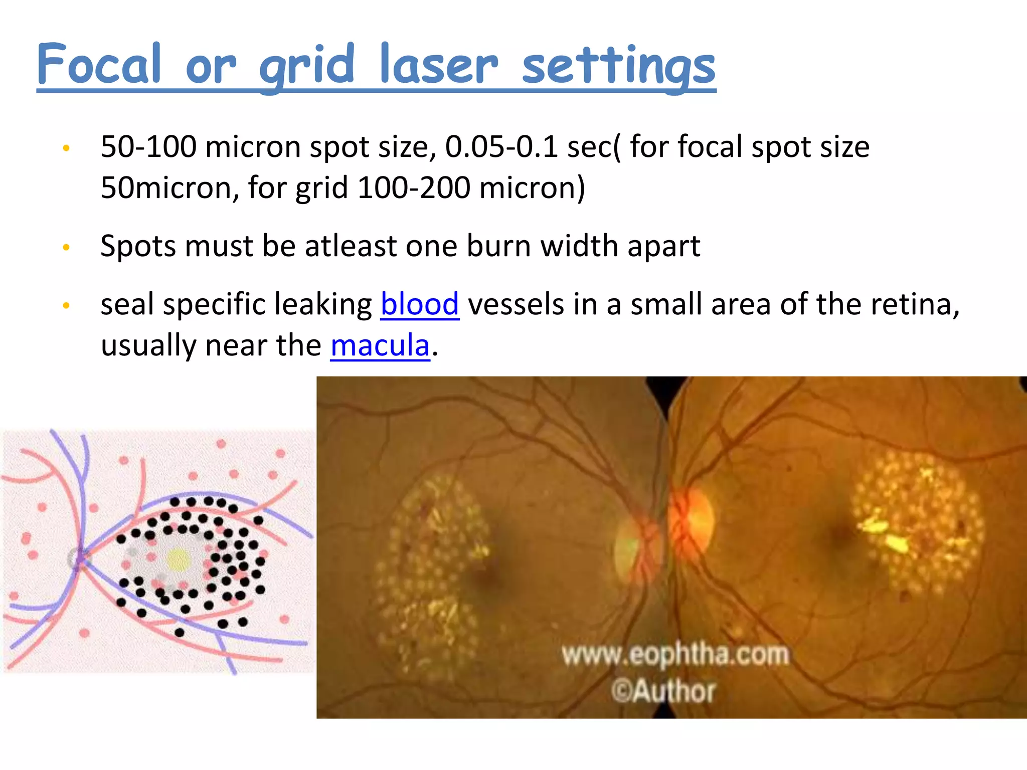 Focal or grid laser settings
•

50-100 micron spot size, 0.05-0.1 sec( for focal spot size
50micron, for grid 100-200 micron)

•

Spots must be atleast one burn width apart

•

seal specific leaking blood vessels in a small area of the retina,
usually near the macula.

 