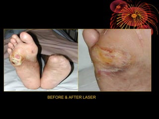 BEFORE & AFTER LASER

 