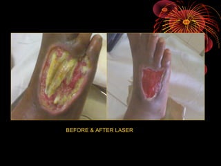 BEFORE & AFTER LASER

 