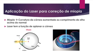 Aplicação do Laser para correção de miopia
 Miopia  Curvatura da córnea aumentada ou comprimento do olho
acima do normal
 Laser tem a função de aplanar a córnea
 