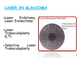 LASER IN GLAUCOMA
Laser Iridotomy,
Laser Iredectomy
Laser
Trabeculoplasty
(LT)
Selective Laser
Trabeculoplasty
 