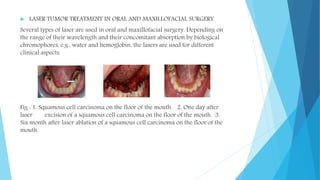  LASER TUMOR TREATMENT IN ORAL AND MAXILLOFACIAL SURGERY
Several types of laser are used in oral and maxillofacial surgery. Depending on
the range of their wavelength and their concomitant absorption by biological
chromophores, e.g., water and hemoglobin, the lasers are used for different
clinical aspects.
Fig : 1. Squamous cell carcinoma on the floor of the mouth. 2. One day after
laser excision of a squamous cell carcinoma on the floor of the mouth. 3.
Six month after laser ablation of a squamous cell carcinoma on the floor of the
mouth.
 