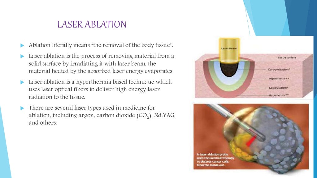 Laser ablation