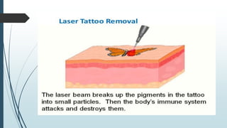 Laser and its application
