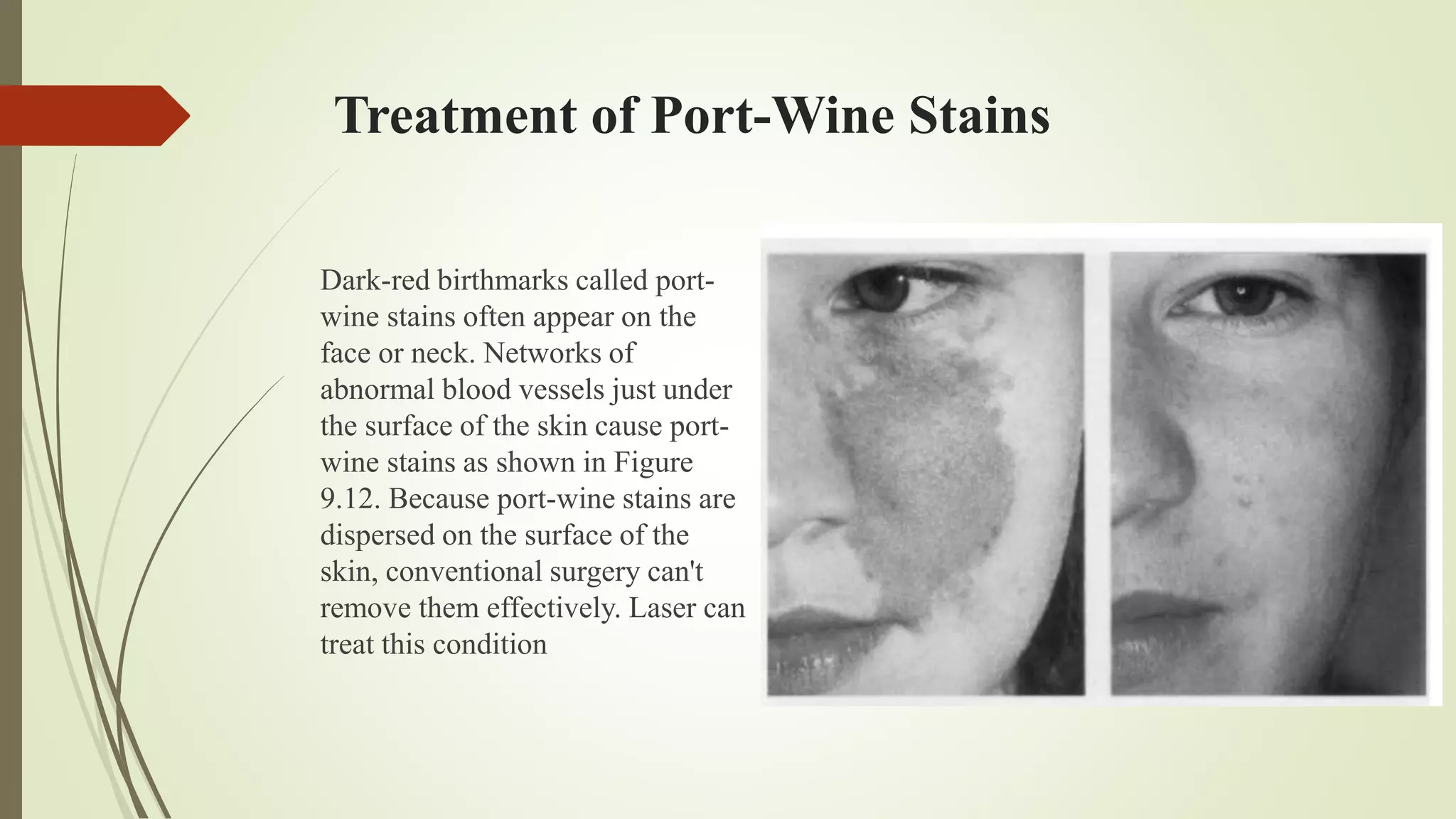 Treatment of Port-Wine Stains
Dark-red birthmarks called port-
wine stains often appear on the
face or neck. Networks of
abnormal blood vessels just under
the surface of the skin cause port-
wine stains as shown in Figure
9.12. Because port-wine stains are
dispersed on the surface of the
skin, conventional surgery can't
remove them effectively. Laser can
treat this condition
 