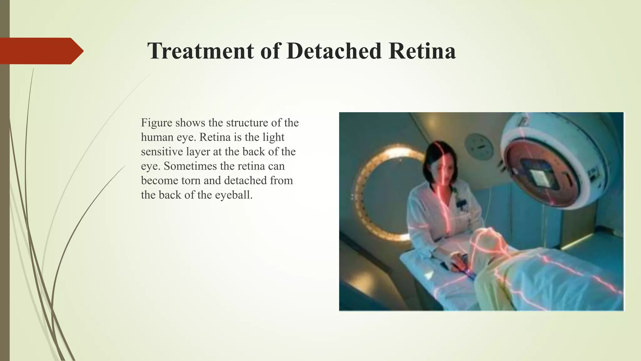 Treatment of Detached Retina
Figure shows the structure of the
human eye. Retina is the light
sensitive layer at the back of the
eye. Sometimes the retina can
become torn and detached from
the back of the eyeball.
 