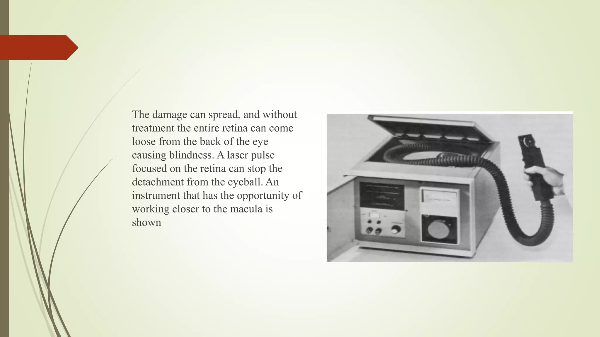 The damage can spread, and without
treatment the entire retina can come
loose from the back of the eye
causing blindness. A laser pulse
focused on the retina can stop the
detachment from the eyeball. An
instrument that has the opportunity of
working closer to the macula is
shown
 