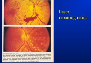 Laser
repairing retina

 