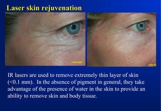 Laser skin rejuvenation

IR lasers are used to remove extremely thin layer of skin
(<0.1 mm). In the absence of pigment in general, they take
advantage of the presence of water in the skin to provide an
ability to remove skin and body tissue.

 