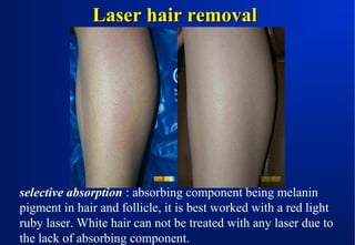 Laser hair removal

selective absorption : absorbing component being melanin
pigment in hair and follicle, it is best worked with a red light
ruby laser. White hair can not be treated with any laser due to
the lack of absorbing component.

 