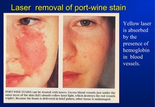 Laser removal of port-wine stain
Yellow laser
is absorbed
by the
presence of
hemoglobin
in blood
vessels.

 