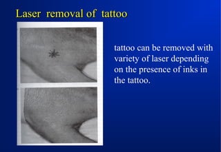 Laser removal of tattoo
tattoo can be removed with
variety of laser depending
on the presence of inks in
the tattoo.

 