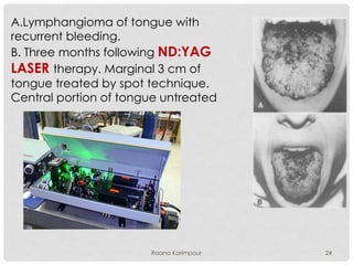 A.Lymphangioma of tongue with
recurrent bleeding.
B. Three months following ND:YAG
LASER therapy. Marginal 3 cm of
tongue treated by spot technique.
Central portion of tongue untreated
24Raana Karimpour
 