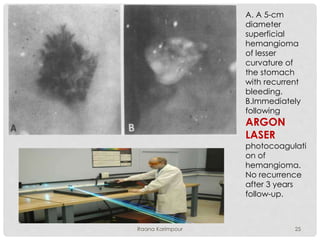 A. A 5-cm
diameter
superficial
hemangioma
of lesser
curvature of
the stomach
with recurrent
bleeding.
B.Immediately
following
ARGON
LASER
photocoagulati
on of
hemangioma.
No recurrence
after 3 years
follow-up.
25Raana Karimpour
 