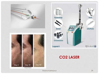 CO2 LASER
29Raana Karimpour
 