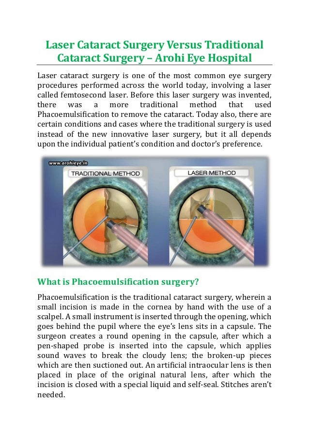 Laser cataract surgery versus traditional cataract surgery