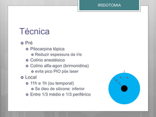 Técnica
 Pré
 Pilocarpina tópica
 Reduzir espessura da íris
 Colírio anestésico
 Colírio alfa-agon (brimonidina)
 evita pico PIO pós laser
 Local
 11h e 1h (ou temporal)
 Se óleo de silicone: inferior
 Entre 1/3 médio e 1/3 periférico
IRIDOTOMIA
 