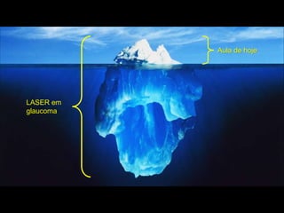 LASER em
glaucoma
Aula de hoje
 