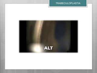 TRABECULOPLASTIA
 