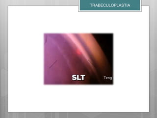 TRABECULOPLASTIA
 