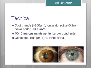 Técnica
 Spot grande (>200µm), longa duração(>0,2s),
baixo poder (<400mW)
 10-15 marcas na íris periférica por quadrante
 Goniolente (tangente) ou lente plana
GONIOPLASTIA
 