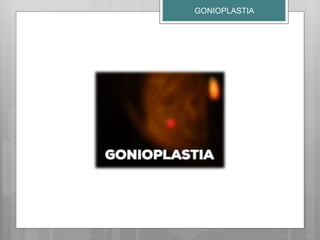 GONIOPLASTIA
 